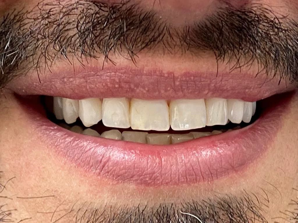 Facetas de porcelana: antes do tratamento