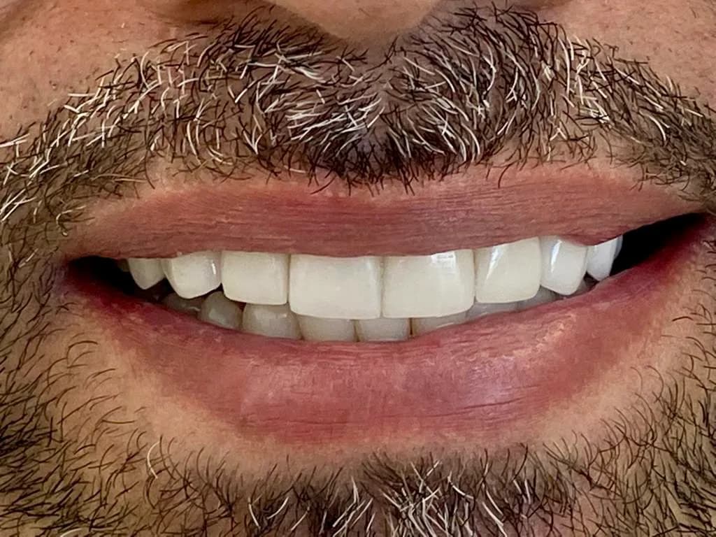 Facetas de porcelana: depois do tratamento