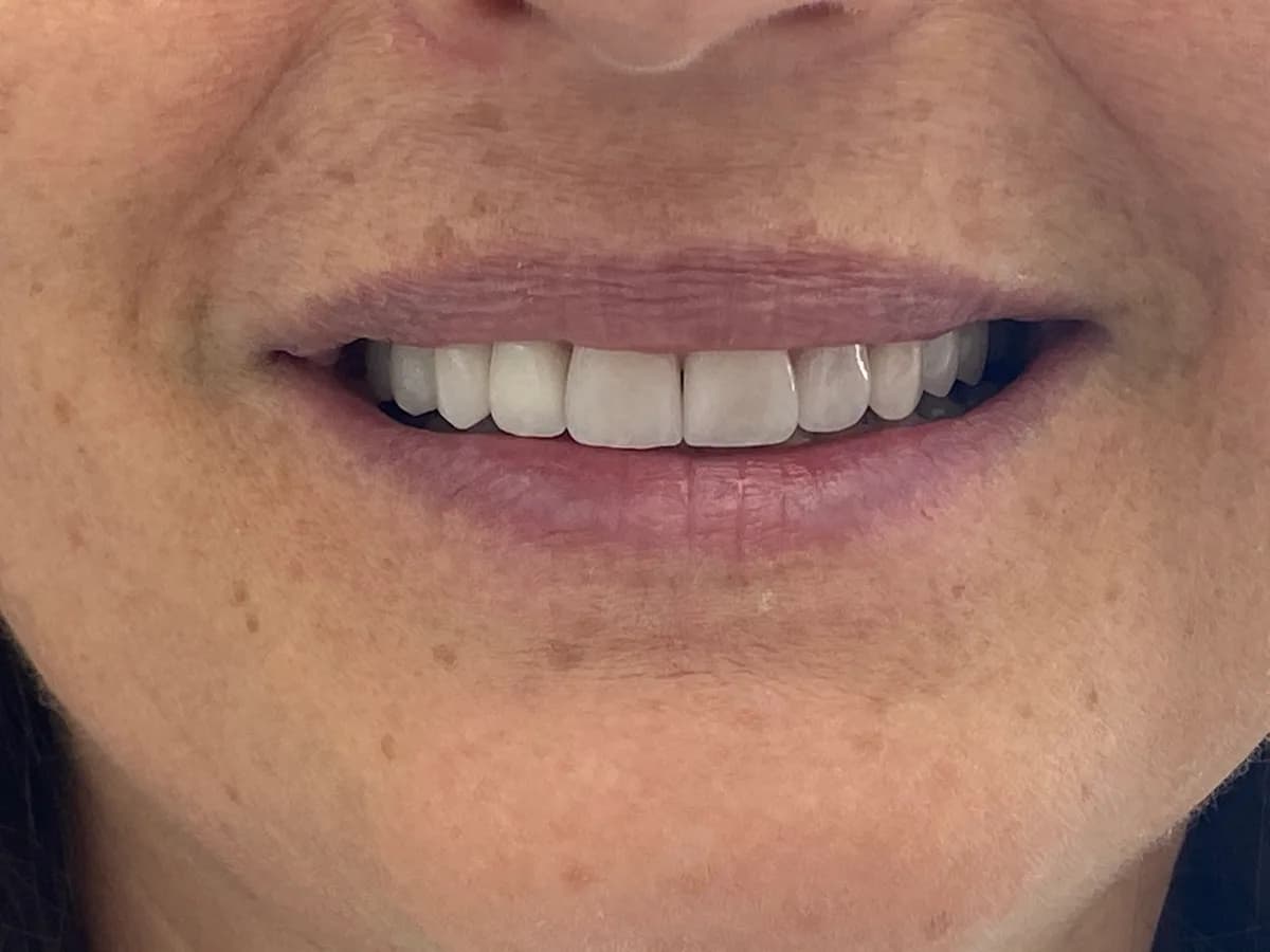 Facetas de porcelana: depois do tratamento
